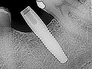 dental implant